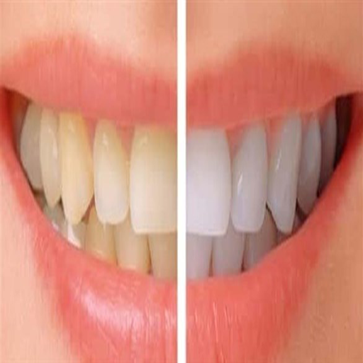 Teeth whitening تبييض الأسنان