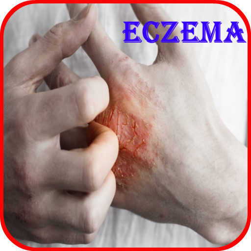 Eczema Causes, Diagnosis, and 