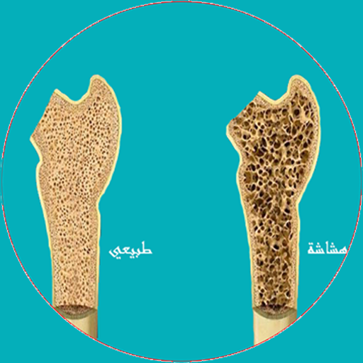 علاج هشاشة العظام