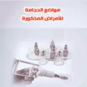 مواضع الحجامة