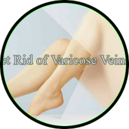 varicose veins guide