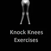 Knock Knees Egzersizleri