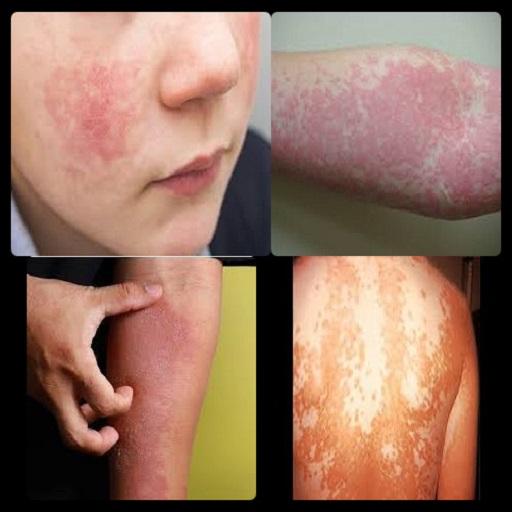 Skin Diseases