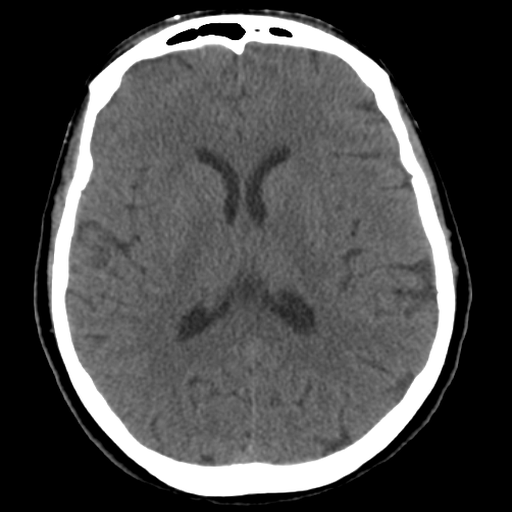 Brain CT : annotated slices