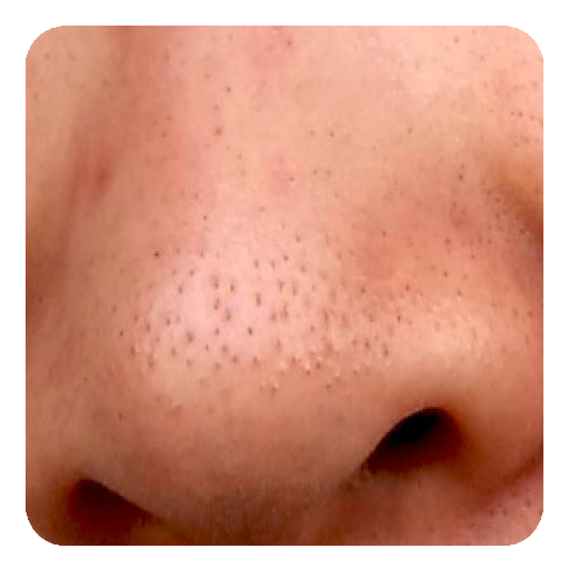 Blackheads Guide