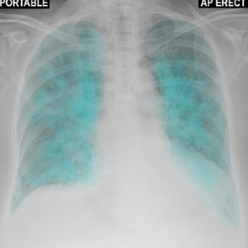 Chest X-Ray And Pathology