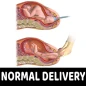 Normal Delivery Tips